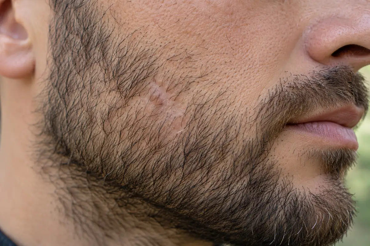 موهای پراکنده ریش در حاشیه اسکار کوتاه گونه
