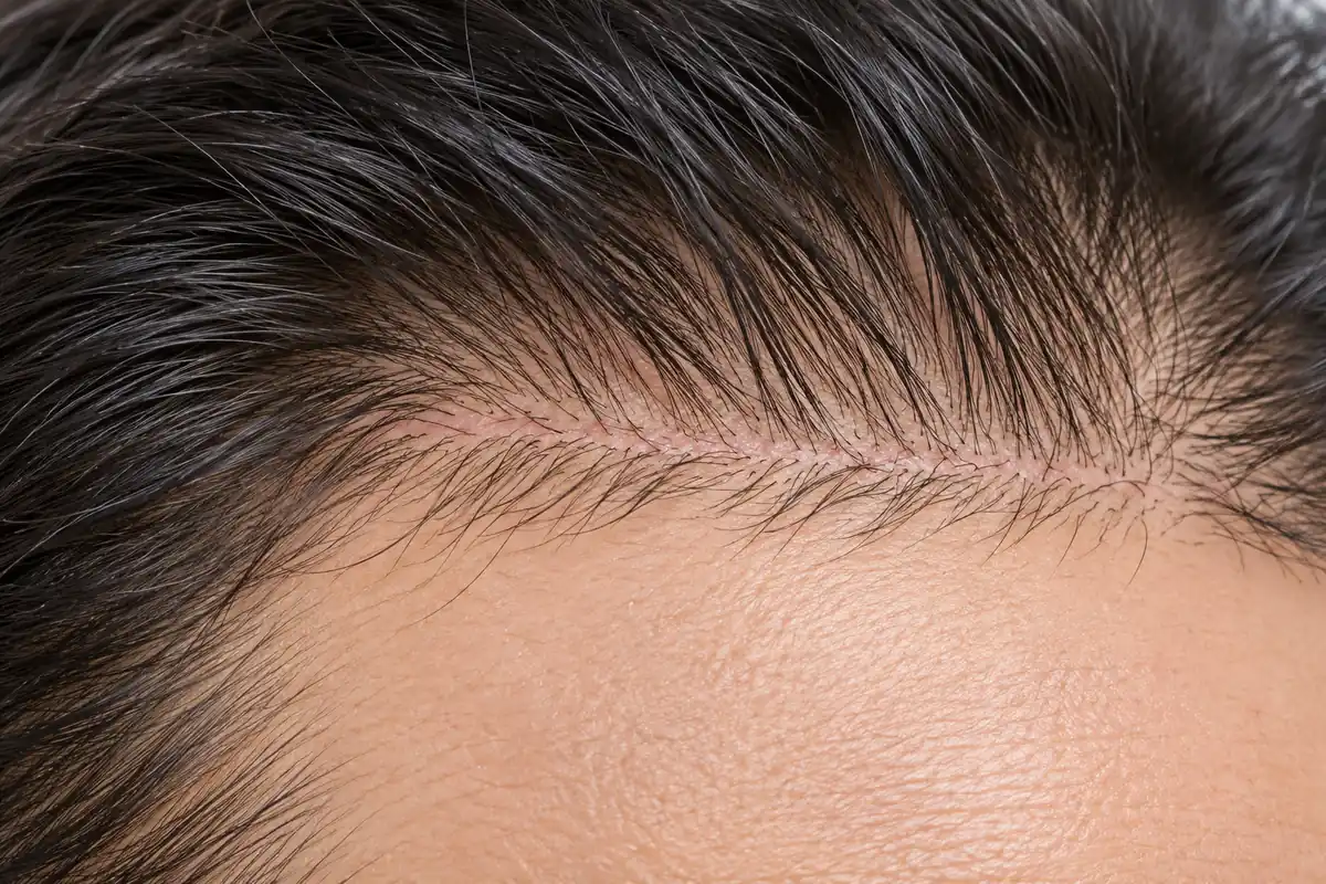 طرح جهت موهای کاشتهشده کنار اسکار خط رویش