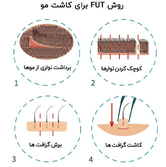 مراحل FUT برای کاشت ابرو