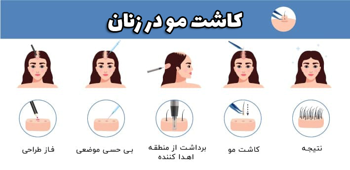 کاشت موی زنان