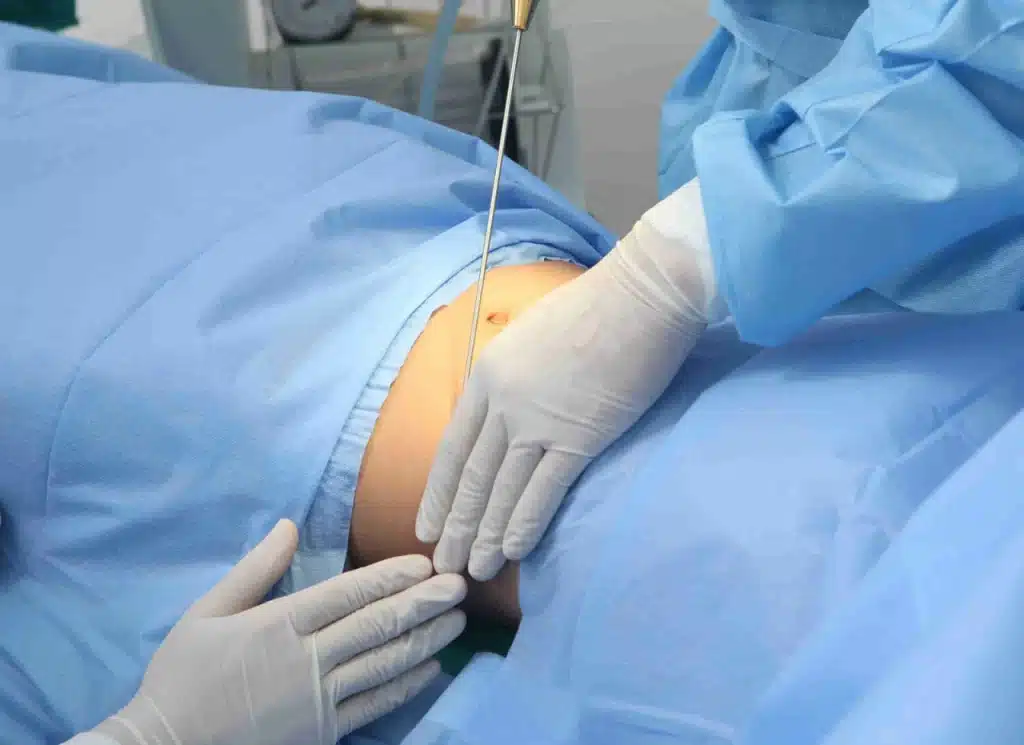 لیپوماتیک ران با استفاده از پیشرفتهترین دستگاهها در کلینیک تخصصی لیما کاشت؛ جهت اطلاعات بیشتر و مشاوره رایگان کلیک کنید.