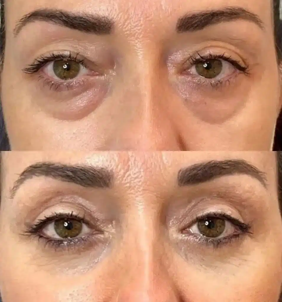 نقش ژنتیک در افتادگی پلک و نیاز به بلفاروپلاستی