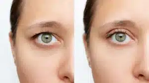 نقش ژنتیک در افتادگی پلک و نیاز به بلفاروپلاستی