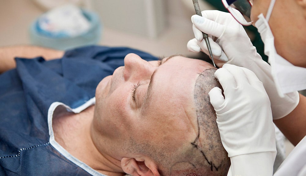 کاشت مو با بانک مو