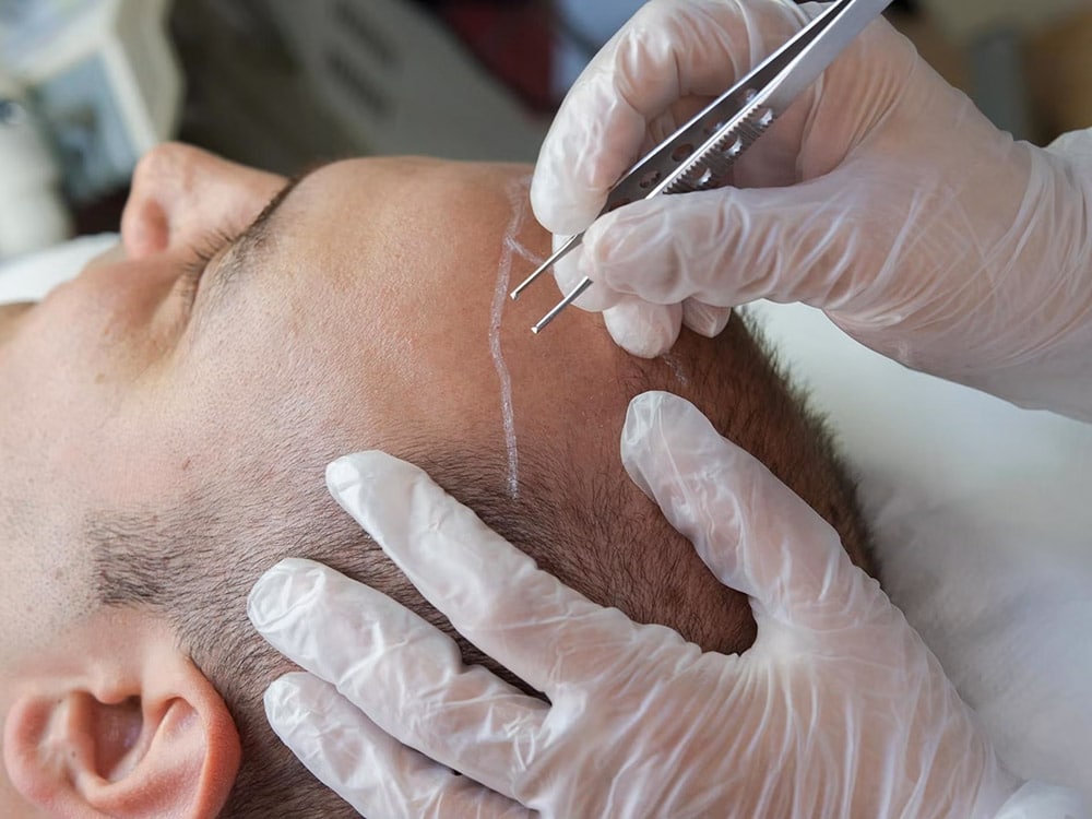 کاشت مو با بانک مو