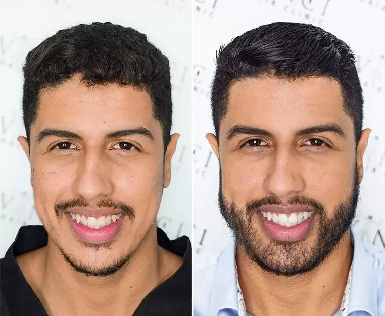 تفاوت کاشت ریش و سبیل با کاشت موی سر