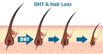 علت افزایش دی هیدروتستوسترون در زنان