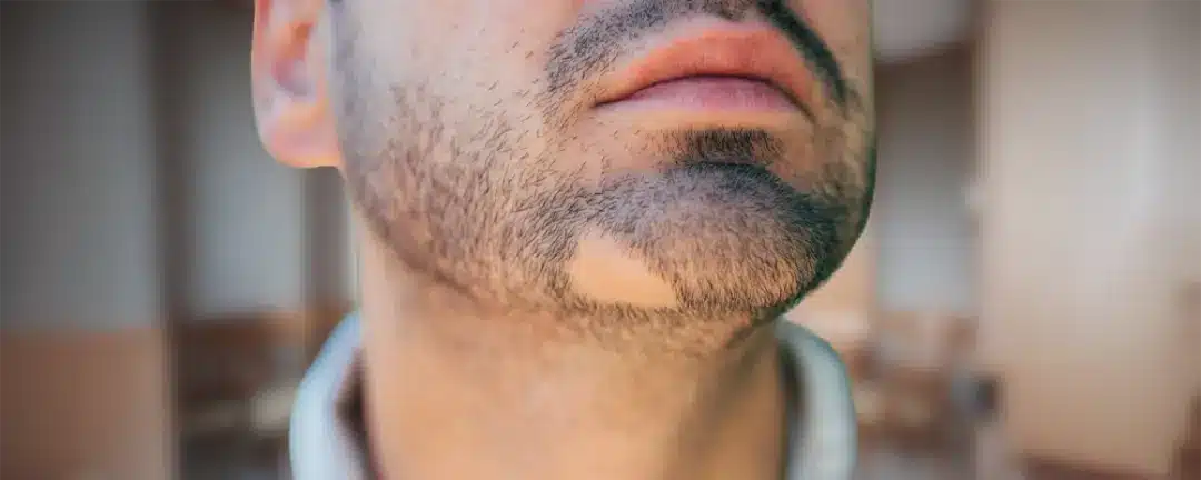 دلایل ریزش ریش و سبیل در مردان