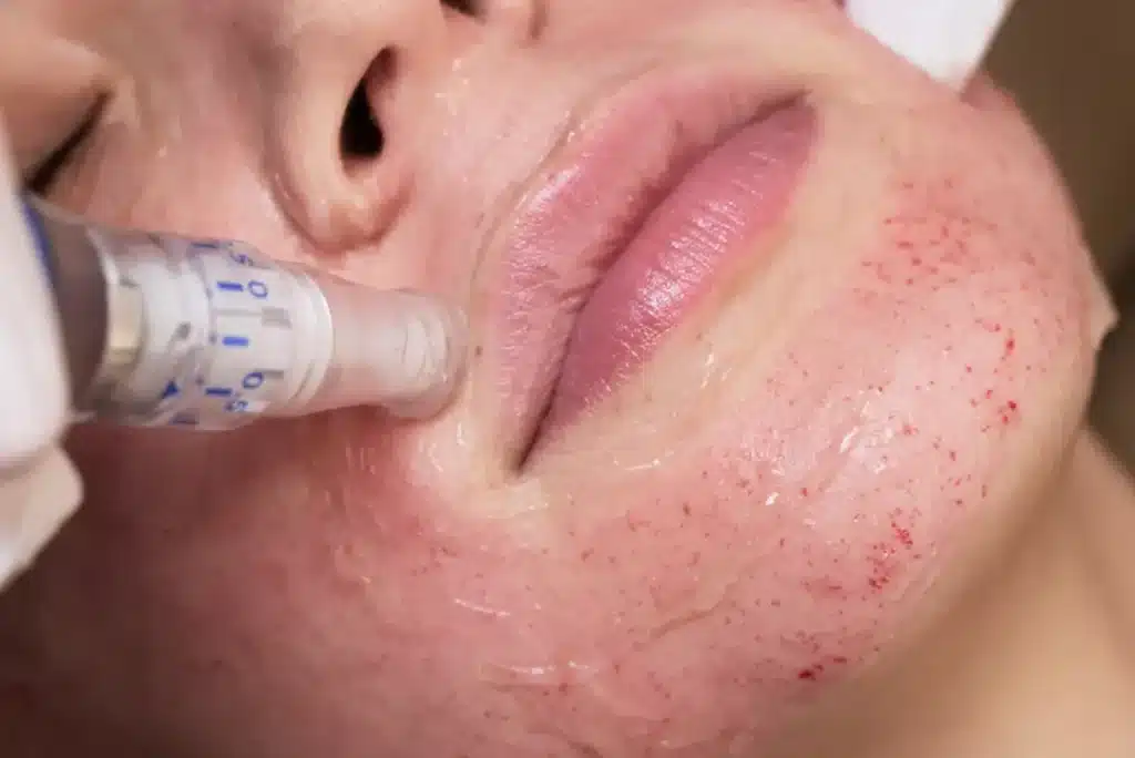 مزونیدلینگ چیست؟ کاربردها و عارض و هزینه آن