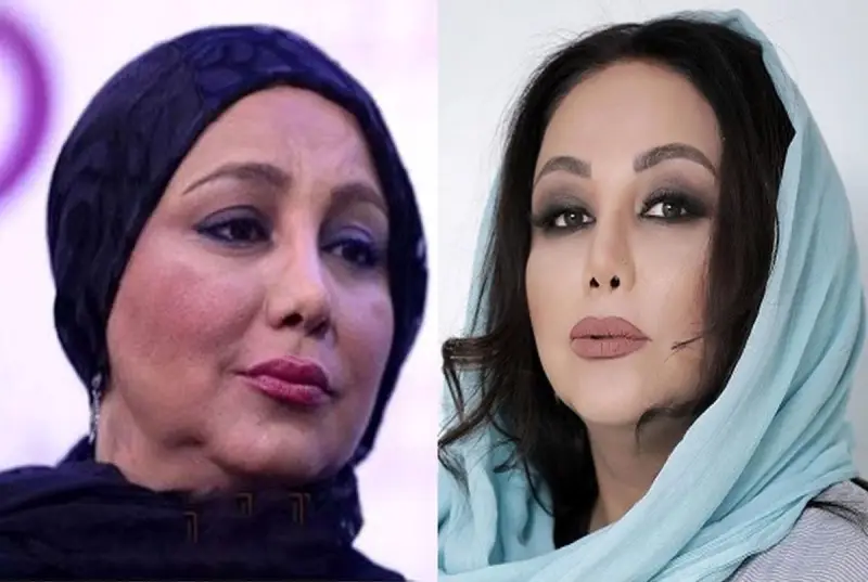 رازهای زیبایی بازیگران زن ایرانی؛ از رینوپلاستی تا کاشت مو