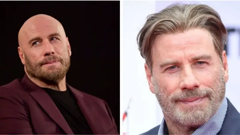 کاشت مو ستارگان هالیوود و راز بازگشت اعتمادبهنفس