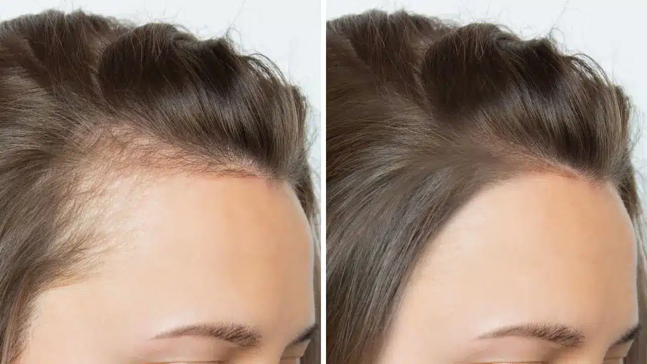 پرولاکتین و ریزش مو | همه چیز درباره ارتباط هورمونها با کاشت مو، ریش و ابرو