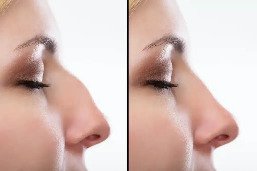 رینوپلاستی چیست؟ هر آنچه باید درباره جراحی زیبایی بینی بدانید