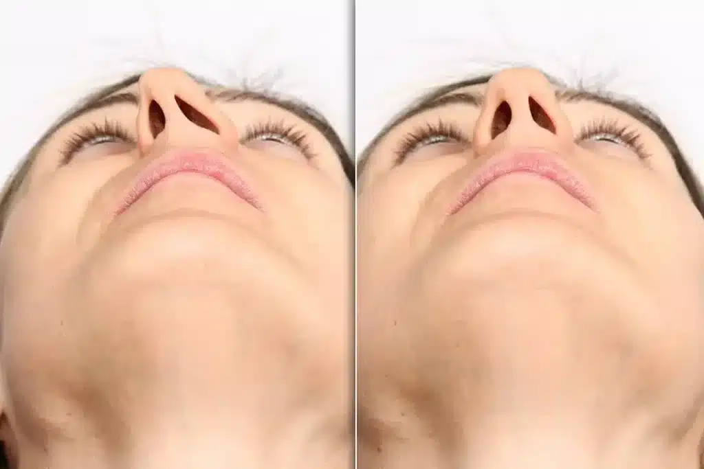 رینوپلاستی چیست؟ هر آنچه باید درباره جراحی زیبایی بینی بدانید