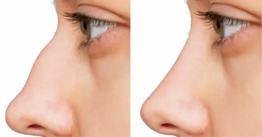 رینوپلاستی چیست؟ هر آنچه باید درباره جراحی زیبایی بینی بدانید