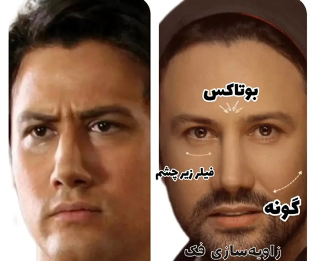 کدام بازیگران مرد ایرانی عمل زیبایی انجام داده‌اند؟