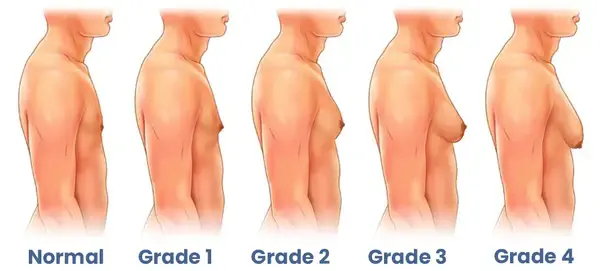 ژنیکوماستی در مردان | علل، علائم و بهترین روشهای درمانی