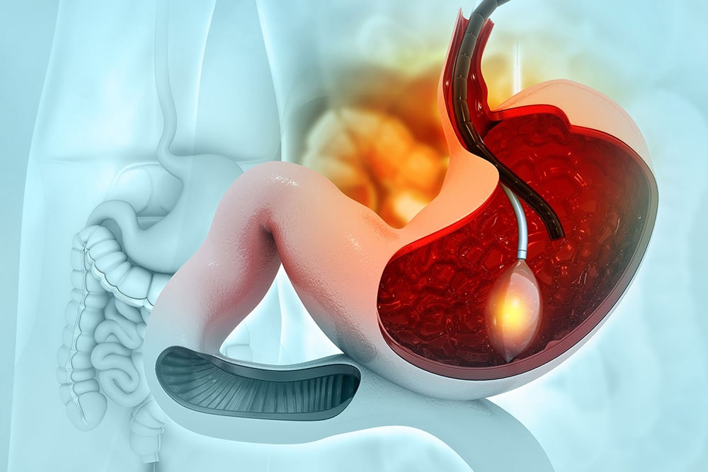 بوتاکس معده