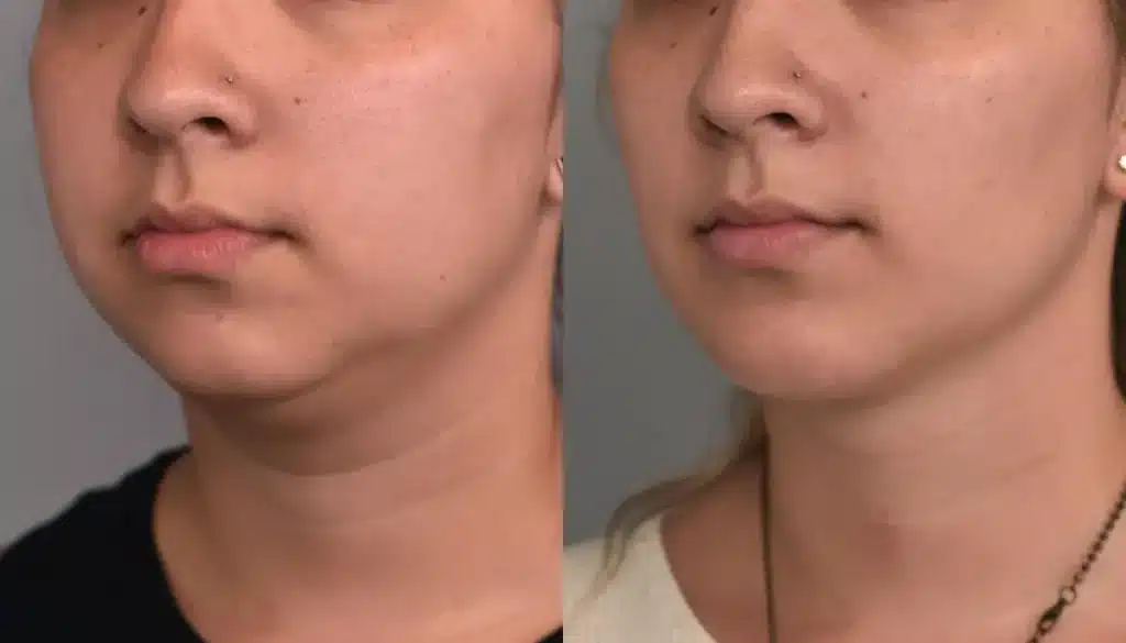 بوکال فت چیست؟ هرآنچه باید درباره جراحی حذف چربی گونه بدانید