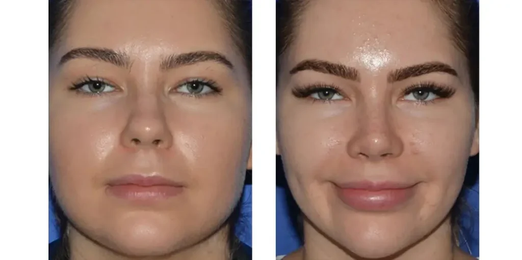 بوکال فت چیست؟ هرآنچه باید درباره جراحی حذف چربی گونه بدانید