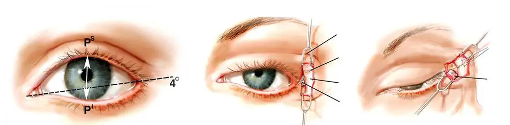 عمل کانتوپلاستی یا چشم گربه‌ای چیست؟ همه چیز درباره جراحی کشیده کردن چشم