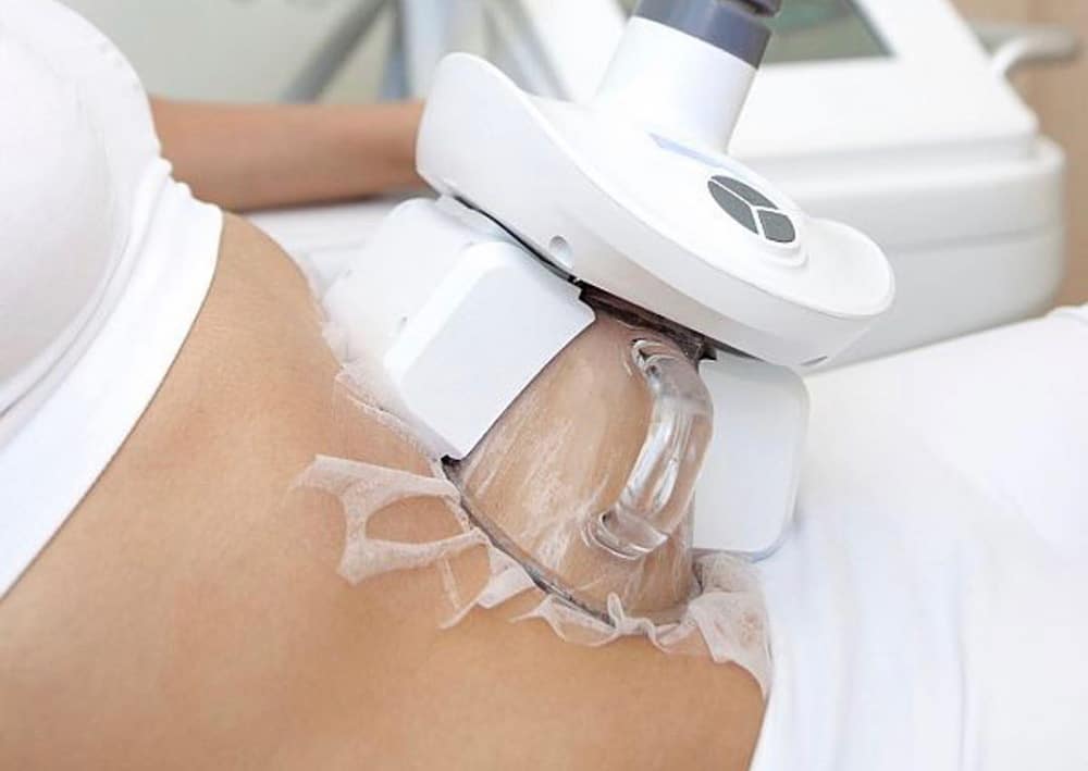 کرایولیپولیز