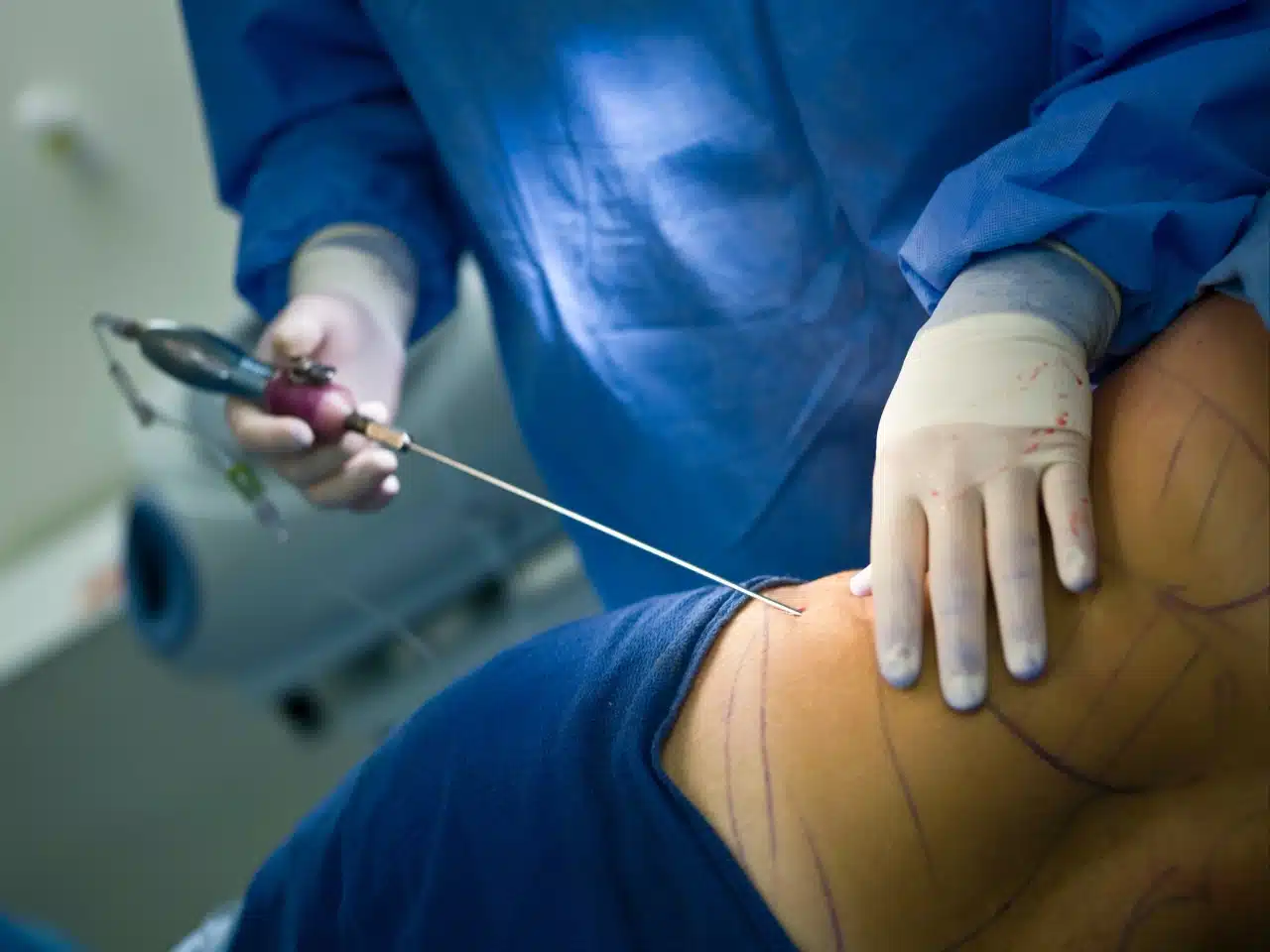 آمبولی بعد از لیپوماتیک