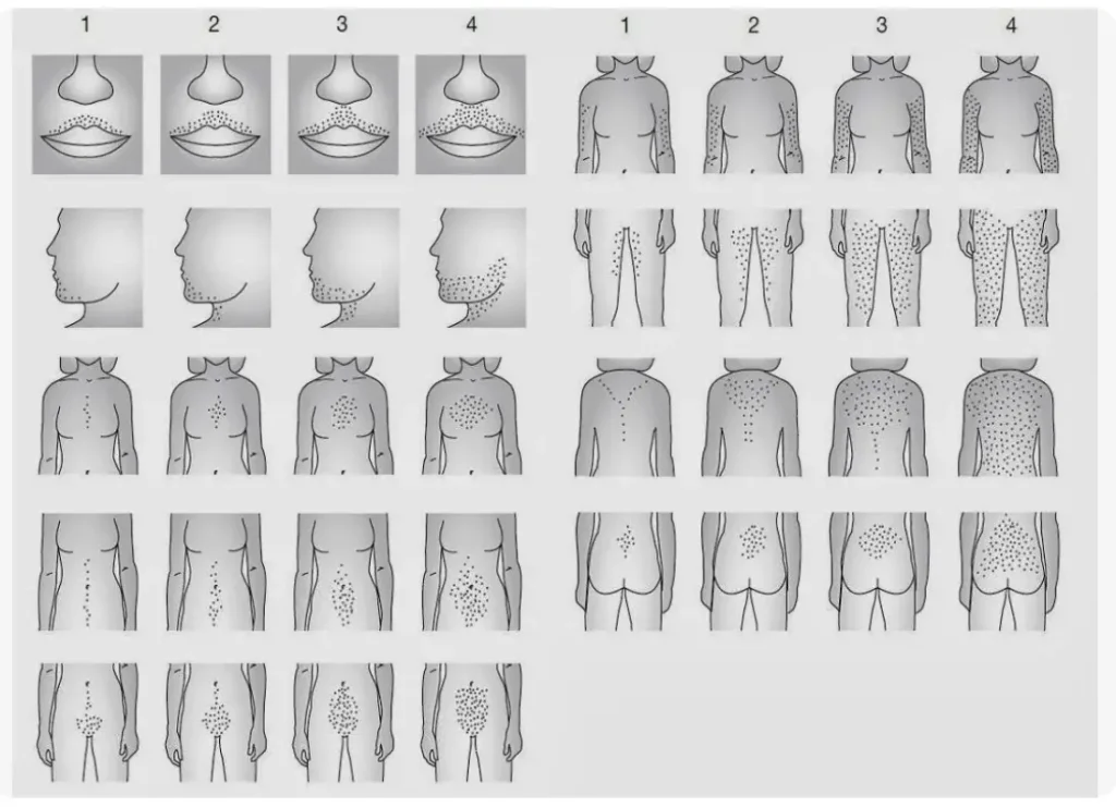هیرسوتیسم یا رشد موهای زائد در زنان | علل، علائم و درمان کامل