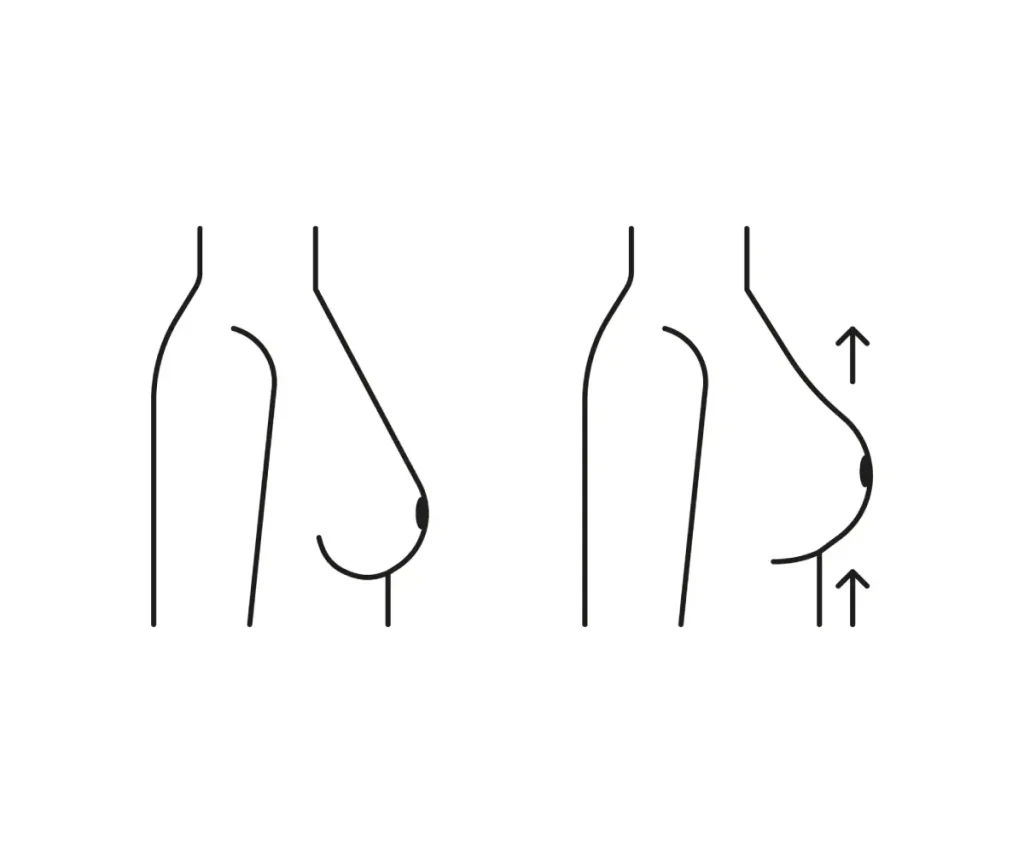 لیفت سینه چیست؟ | مراحل، مزایا، هزینه و روش‌های لیفت سینه در ایران