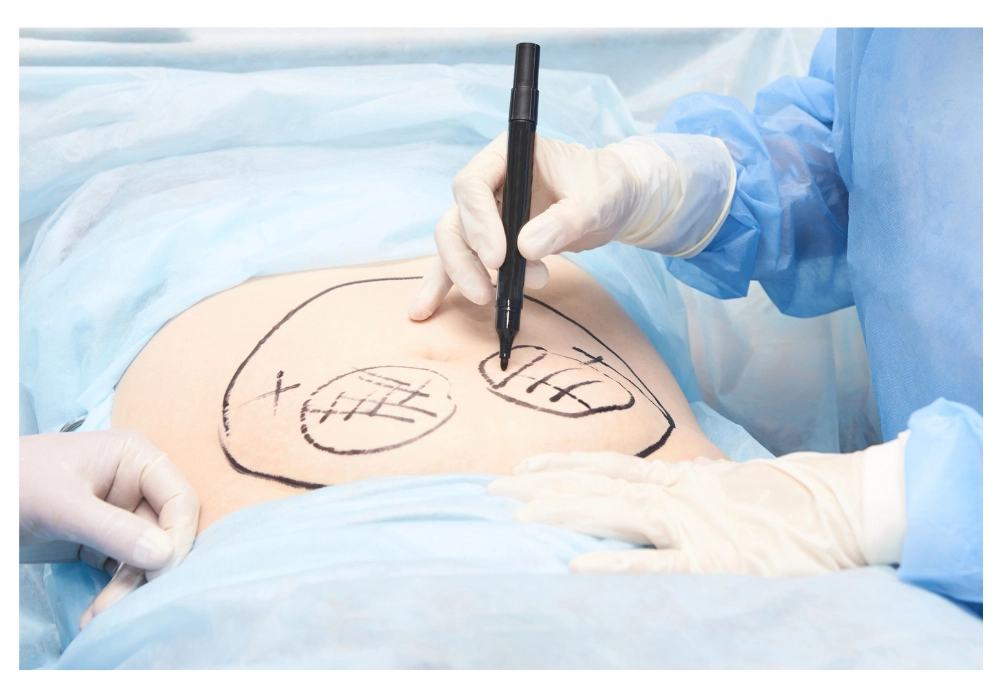 پیکرتراشی بدن (بادی کانتورینگ) | روش‌ها، مزایا و مراقبت‌ها