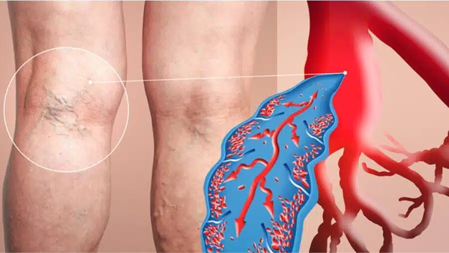 چطور رگ‌های واریس را از بین ببریم؟