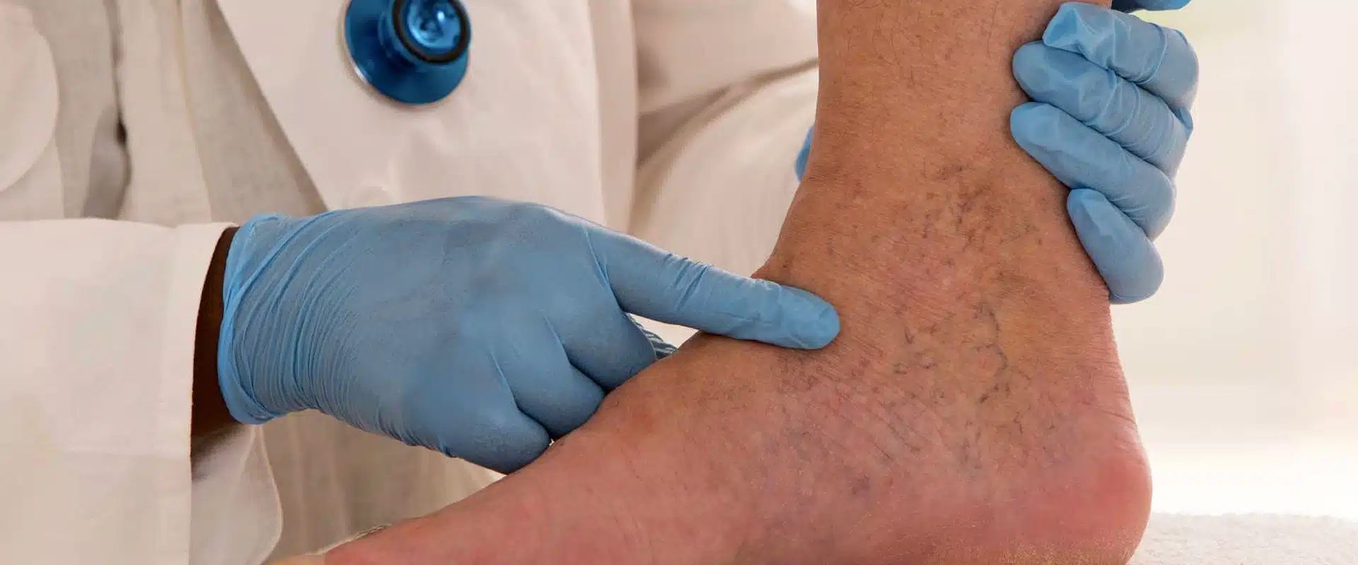 چطور رگهای واریس را از بین ببریم؟