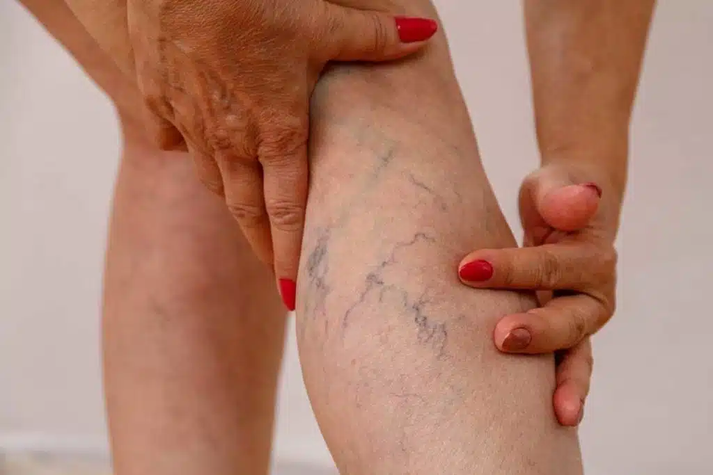 چطور رگ‌های واریس را از بین ببریم؟