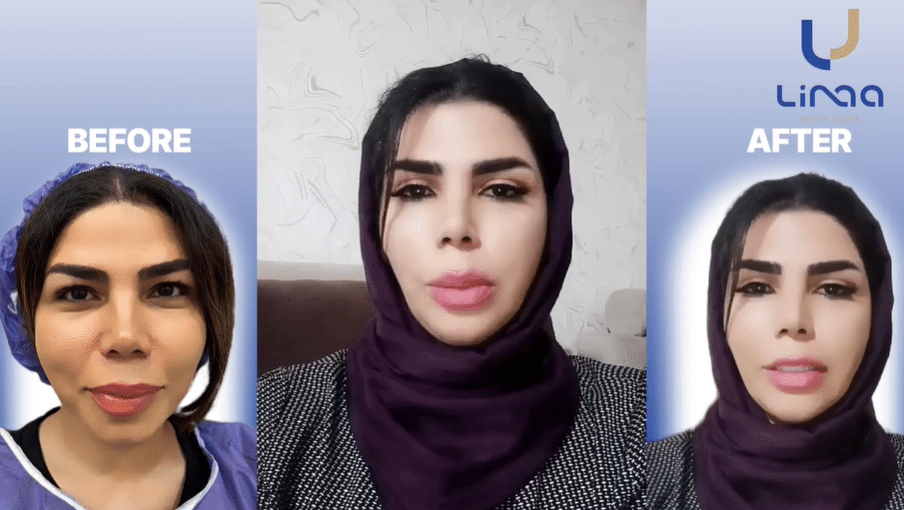 فیلم رضایت بلفاروپلاستی