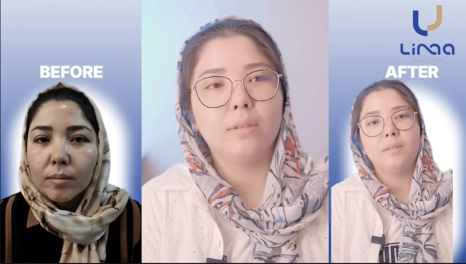 رضایت عمل بلفاروپلاستی