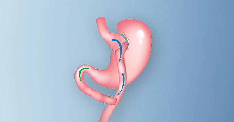 لاغری با بای پس معده یا لیپوماتیک؛ کدام برای شما بهتر است؟