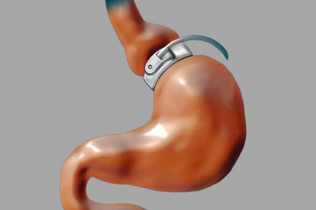 لاغری با حلقه معده یا لیپوماتیک؛ کدام روش انتخاب بهتری است؟