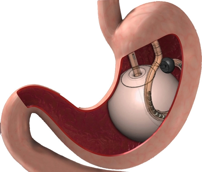 بالن معده یا لیپوماتیک؟ بررسی تفاوتها، مزایا و بهترین انتخاب با لیما کاشت