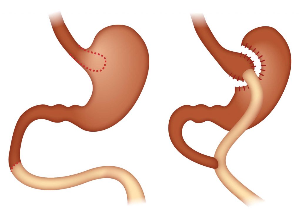 لاغری با بای پس معده یا لیپوماتیک؛ کدام برای شما بهتر است؟