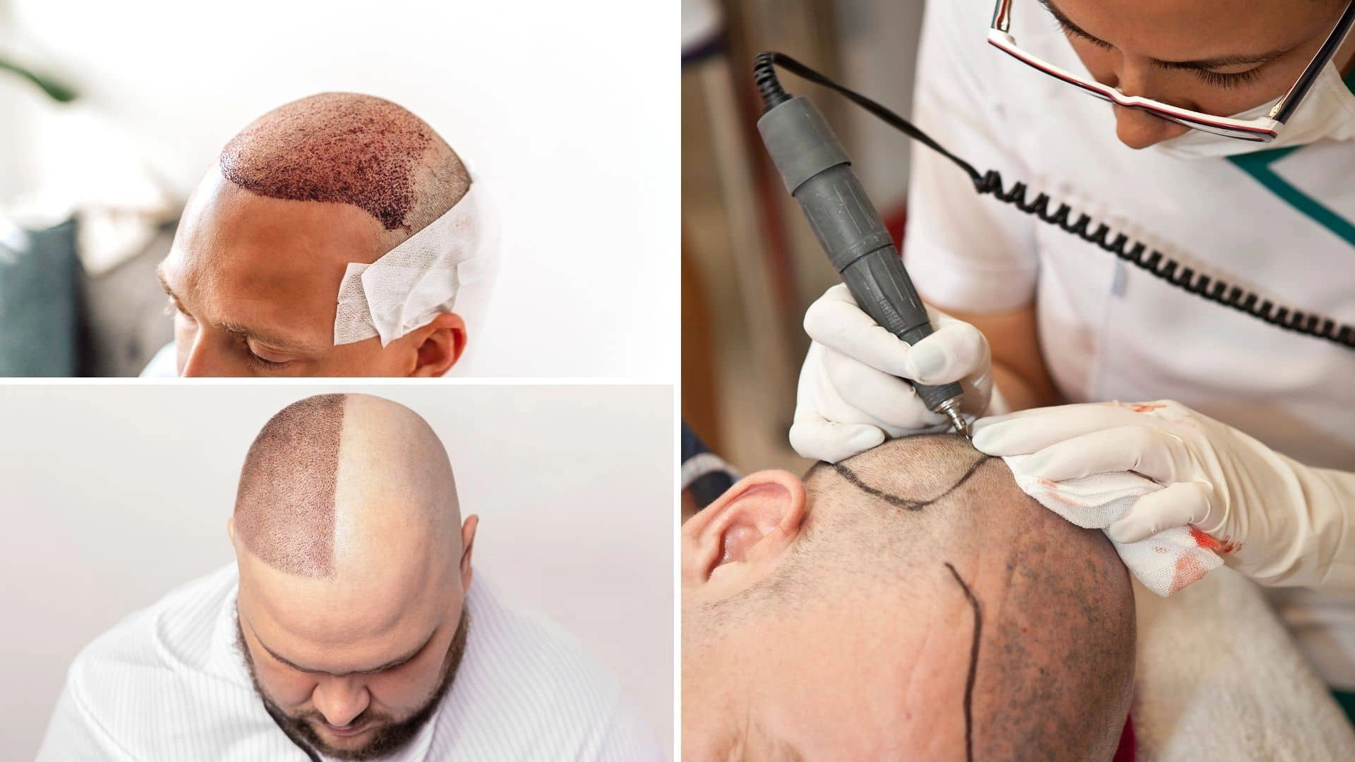 ترکیه با ۳۰۰۰ کلینیک کاشت مو و قیمتهای رقابتی، به مقصد اول توریسم درمانی مردان در جهان تبدیل شده است.